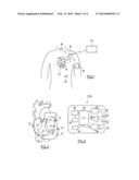 AUTONOMOUS INTRACARDIAC IMPLANTABLE MEDICAL DEVICE WITH RELEASEABLE BASE     AND FASTENER ELEMENT diagram and image