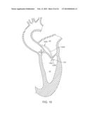 Heart Valve Prosthesis diagram and image