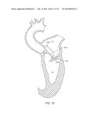 Heart Valve Prosthesis diagram and image