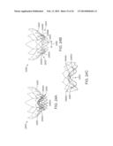 Heart Valve Prosthesis diagram and image