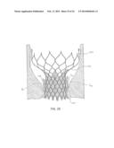 Heart Valve Prosthesis diagram and image