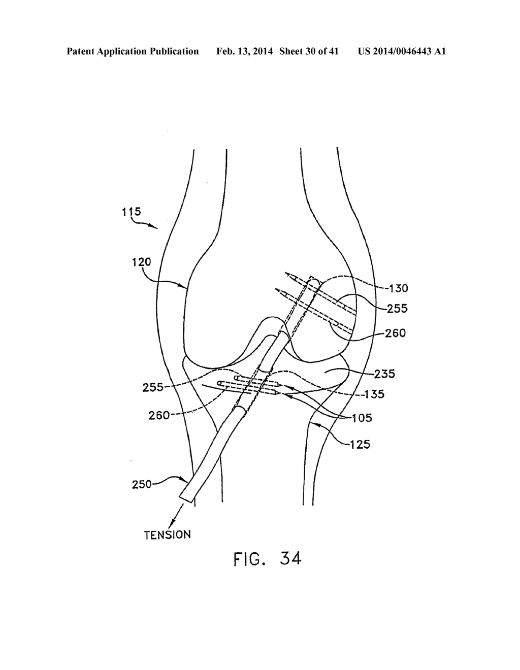 METHOD AND APPARATUS FOR FIXING A GRAFT IN A BONE TUNNEL - diagram, schematic, and image 31