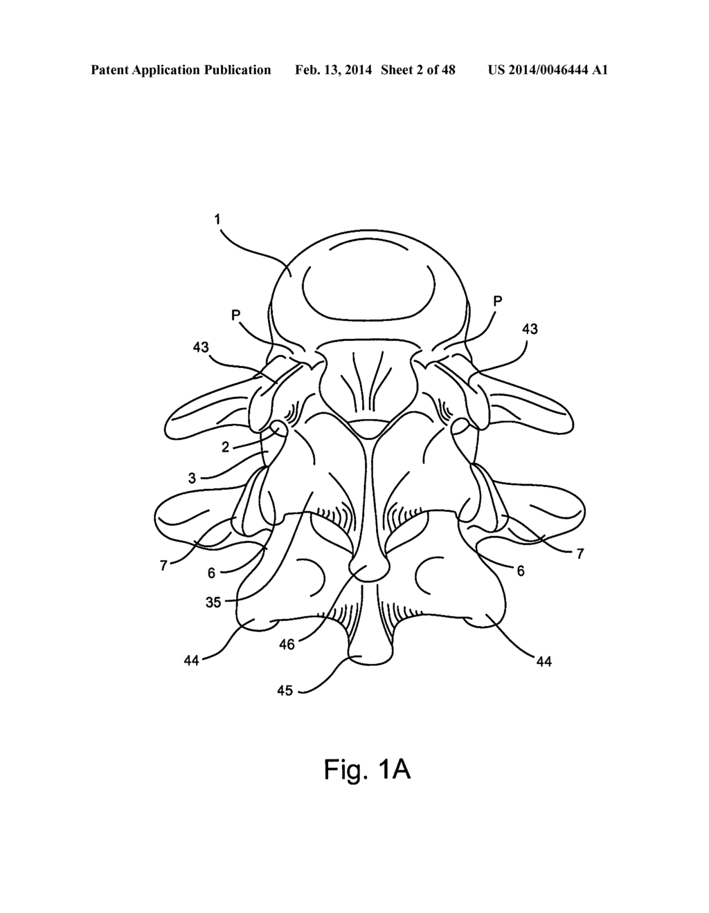 Facet Joint Replacement - diagram, schematic, and image 03