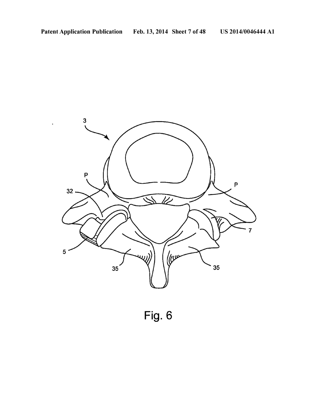 Facet Joint Replacement - diagram, schematic, and image 08