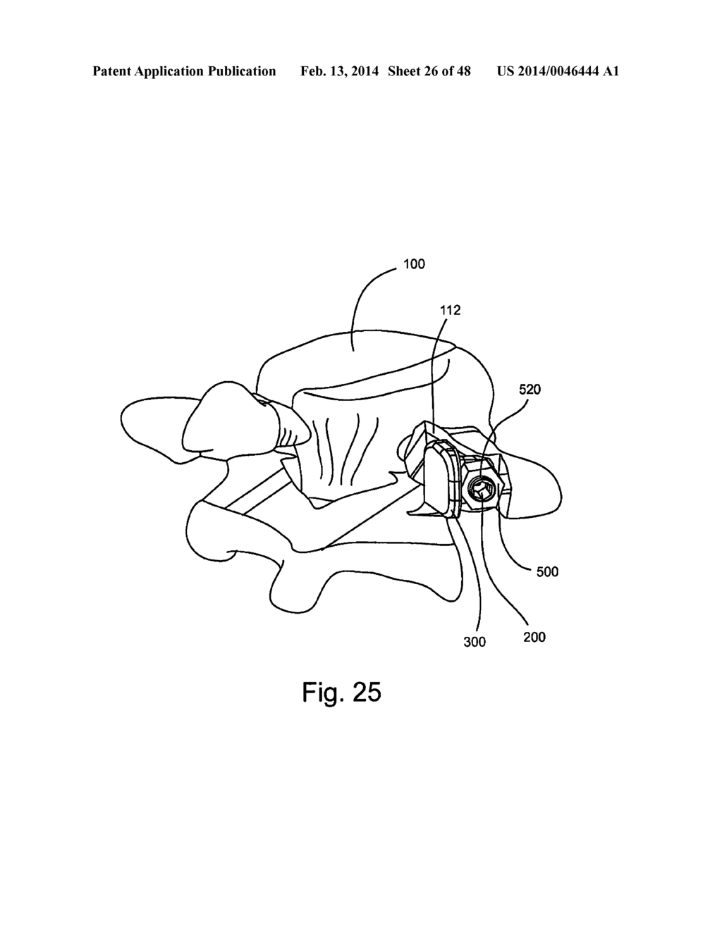 Facet Joint Replacement - diagram, schematic, and image 27