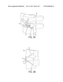 INTERBODY FUSION DEVICE diagram and image