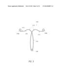 INTRAUTERINE CONTRACEPTIVE DEVICE diagram and image