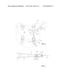 SONOTRODE FOR THE INTRODUCTION OF ULTRASONIC ENERGY diagram and image