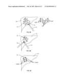 METHOD & APPARATUS FOR SOLID ORGAN TISSUE APPROXIMATION diagram and image