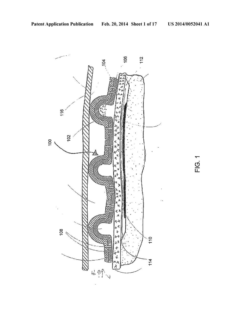 MEDICAL PROTRUDED PADS OR DRESSINGS FOR WOUND CARE INCLUDING USE WITH     ORTHOPEDIC AND PROSTHETIC DEVICES - diagram, schematic, and image 02