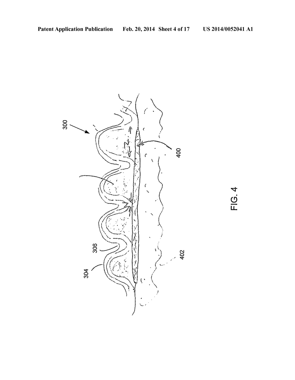 MEDICAL PROTRUDED PADS OR DRESSINGS FOR WOUND CARE INCLUDING USE WITH     ORTHOPEDIC AND PROSTHETIC DEVICES - diagram, schematic, and image 05