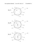 Infusion Sleeve with Motion Reduction Profile diagram and image