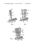 Derotation Apparatus for Treating Spinal Irregularities diagram and image