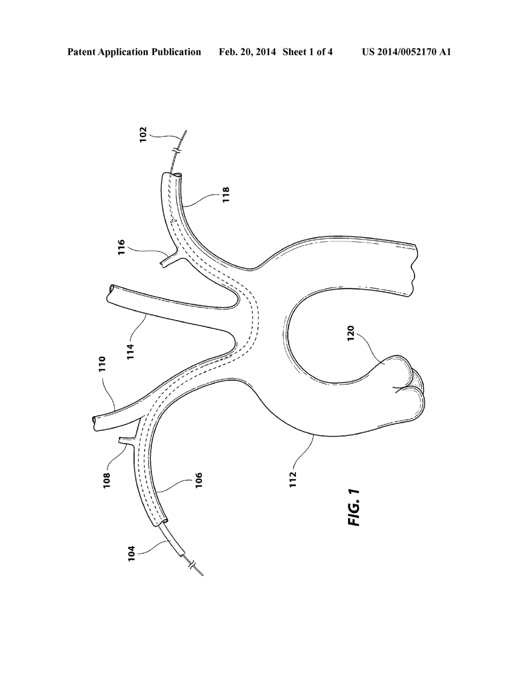 EMBOLISM PROTECTION DEVICE - diagram, schematic, and image 02