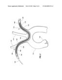 EMBOLISM PROTECTION DEVICE diagram and image