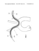 EMBOLISM PROTECTION DEVICE diagram and image