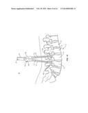 SPINAL IMPLANT SYSTEM AND METHOD diagram and image