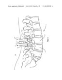 SPINAL IMPLANT SYSTEM AND METHOD diagram and image