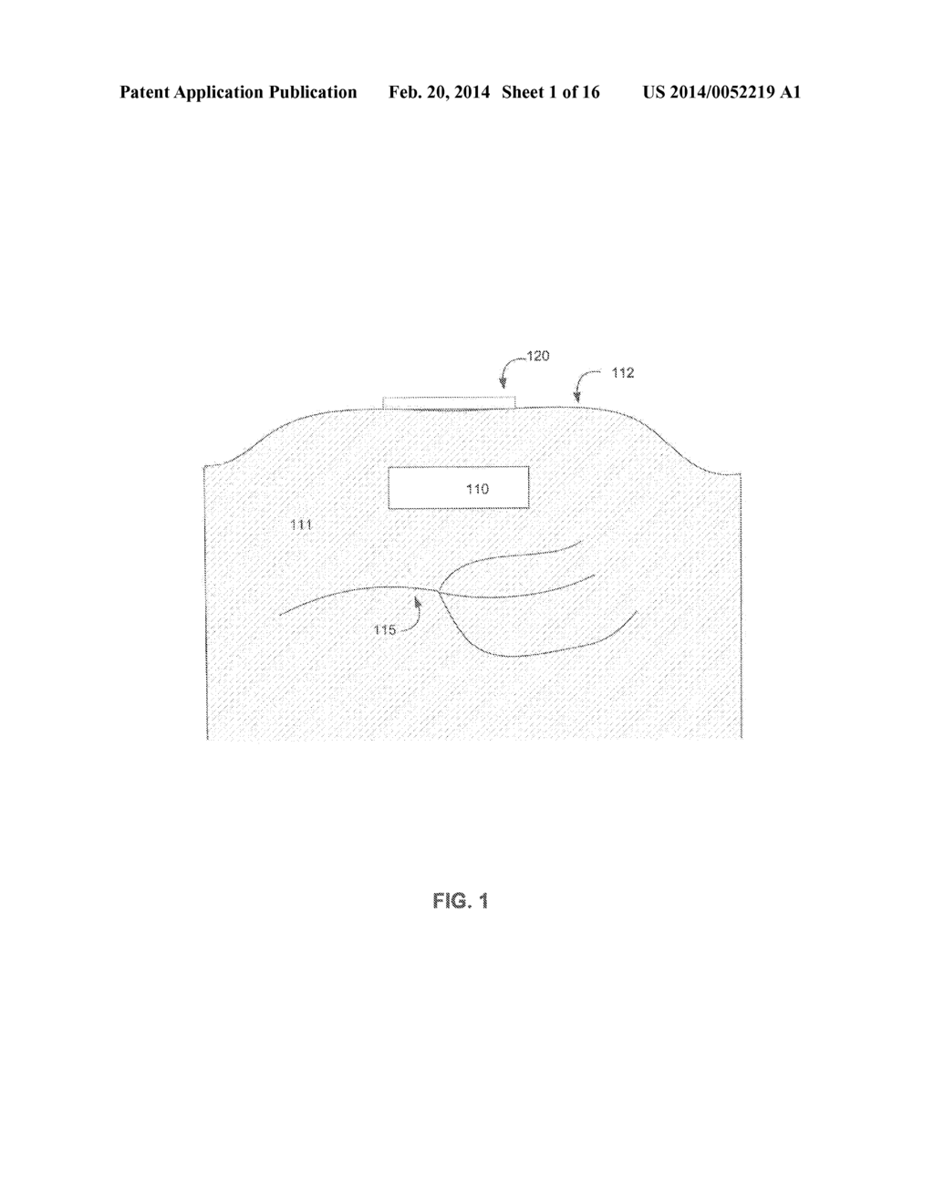 Transcutaneous Power Conveyance Device - diagram, schematic, and image 02