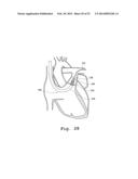 DEVICES AND METHODS FOR DELIVERY OF VALVE PROSTHESES diagram and image