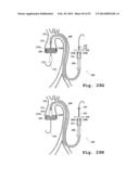 DEVICES AND METHODS FOR DELIVERY OF VALVE PROSTHESES diagram and image