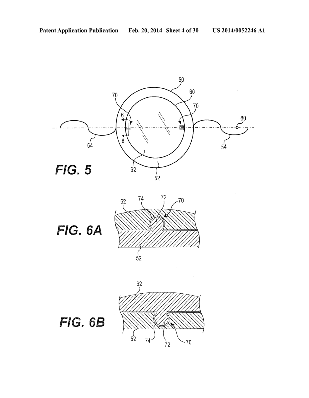 MODULAR INTRAOCULAR LENS DESIGNS AND METHODS - diagram, schematic, and image 05