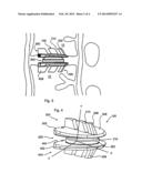 Spine Stabilization Device and Methods diagram and image