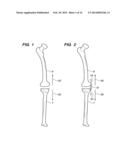 EXTRA-ARTICULAR IMPLANTABLE MECHANICAL ENERGY ABSORBING ASSEMBLIES HAVING     TWO DEFLECTING MEMBERS AND METHODS diagram and image