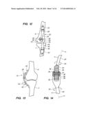 EXTRA-ARTICULAR IMPLANTABLE MECHANICAL ENERGY ABSORBING ASSEMBLIES HAVING     TWO DEFLECTING MEMBERS AND METHODS diagram and image