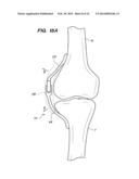 EXTRA-ARTICULAR IMPLANTABLE MECHANICAL ENERGY ABSORBING ASSEMBLIES HAVING     TWO DEFLECTING MEMBERS AND METHODS diagram and image