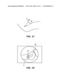 EXTRA-ARTICULAR IMPLANTABLE MECHANICAL ENERGY ABSORBING ASSEMBLIES HAVING     TWO DEFLECTING MEMBERS AND METHODS diagram and image