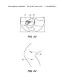 EXTRA-ARTICULAR IMPLANTABLE MECHANICAL ENERGY ABSORBING ASSEMBLIES HAVING     TWO DEFLECTING MEMBERS AND METHODS diagram and image