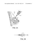 IMPLANTS AND BIODEGRADABLE FIDUCIAL MARKERS diagram and image