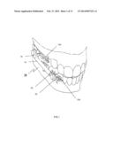 ORTHODONTIC BITE JUMPING DEVICE diagram and image