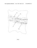 ORTHODONTIC BITE JUMPING DEVICE diagram and image