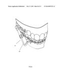 ORTHODONTIC BITE JUMPING DEVICE diagram and image