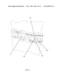 ORTHODONTIC BITE JUMPING DEVICE diagram and image