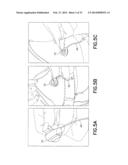 Subcutaneous Infusion Device diagram and image