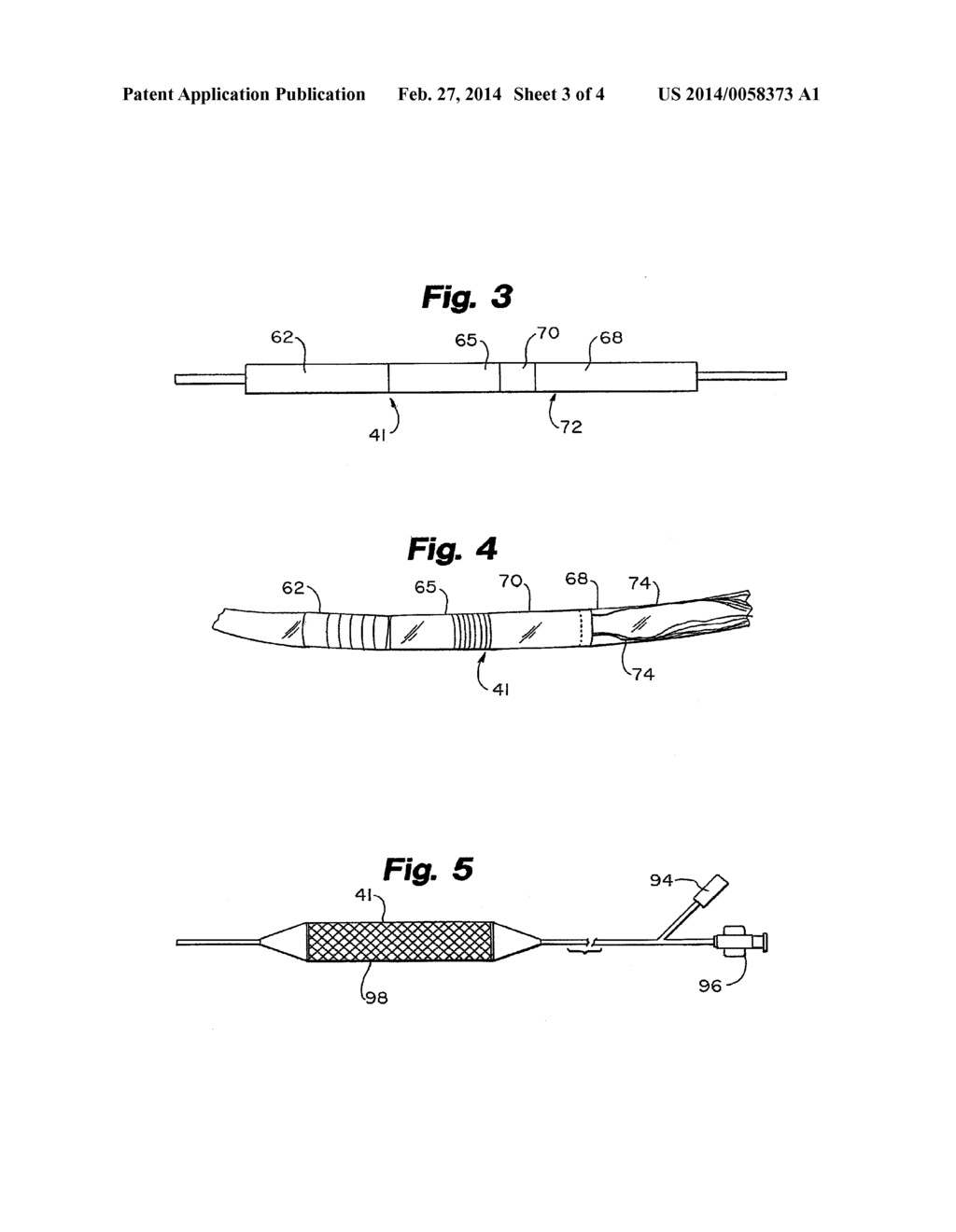 SYSTEM AND METHOD OF TREATING ABNORMAL TISSUE IN THE HUMAN ESOPHAGUS - diagram, schematic, and image 04