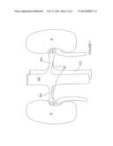 METHODS AND APPARATUS FOR RENAL NEUROMODULATION diagram and image