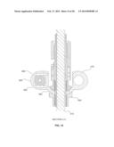 BONE TRANSPORT EXTERNAL FIXATION FRAME diagram and image