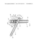 IMPLANT SYSTEM FOR BONE FIXATION diagram and image