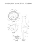 METHOD FOR ROBOTIC ARTHROPLASTY USING NAVIGATION diagram and image