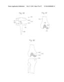 METHOD FOR ROBOTIC ARTHROPLASTY USING NAVIGATION diagram and image