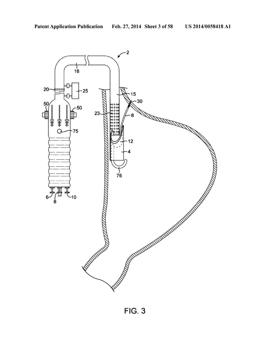 METHODS AND DEVICES FOR MANIPULATING AND FASTENING TISSUE - diagram, schematic, and image 04