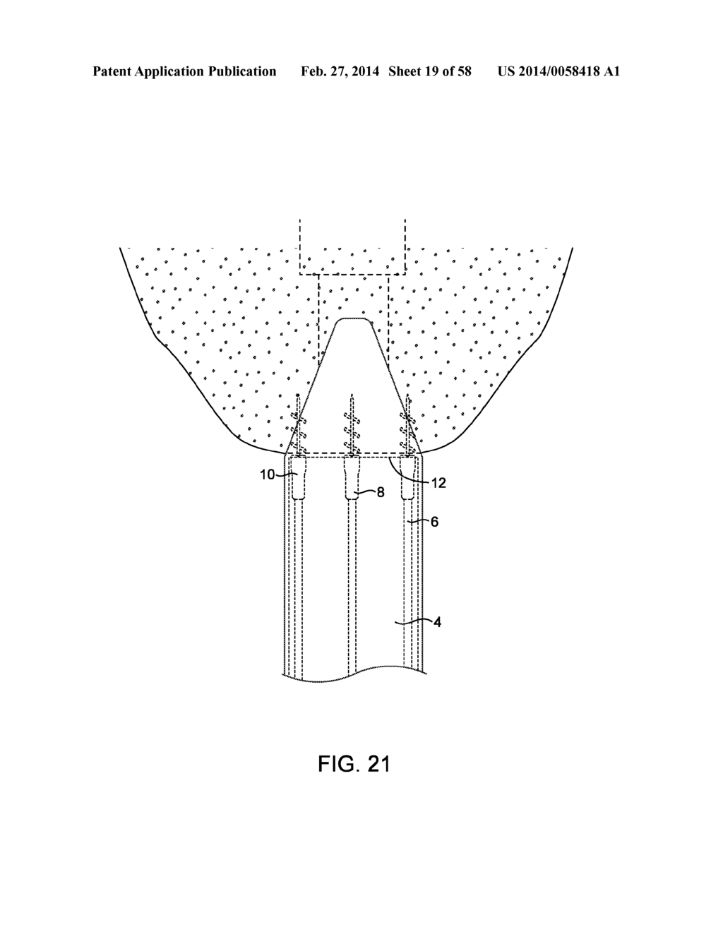 METHODS AND DEVICES FOR MANIPULATING AND FASTENING TISSUE - diagram, schematic, and image 20