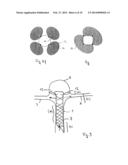 IMPLANT, ESPECIALLY FOR THE OCCLUSION OF BIFURCATION ANEURYSMS diagram and image