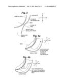 INTRANASAL BONE REMODELING DEVICES AND THEIR PLACE IN MINIMALLY INVASIVE     SINUS PROCEDURES diagram and image