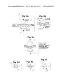 INTRANASAL BONE REMODELING DEVICES AND THEIR PLACE IN MINIMALLY INVASIVE     SINUS PROCEDURES diagram and image