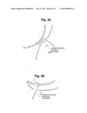 INTRANASAL BONE REMODELING DEVICES AND THEIR PLACE IN MINIMALLY INVASIVE     SINUS PROCEDURES diagram and image
